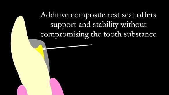 Finlay's Case Study Newsletter 40 - Immediate Mk 1 RPD to Definitive Mk 2 RPD - full protocol