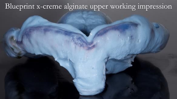 Newsletter 53 showing the making and fitting of ultra life-like dentures for Valena