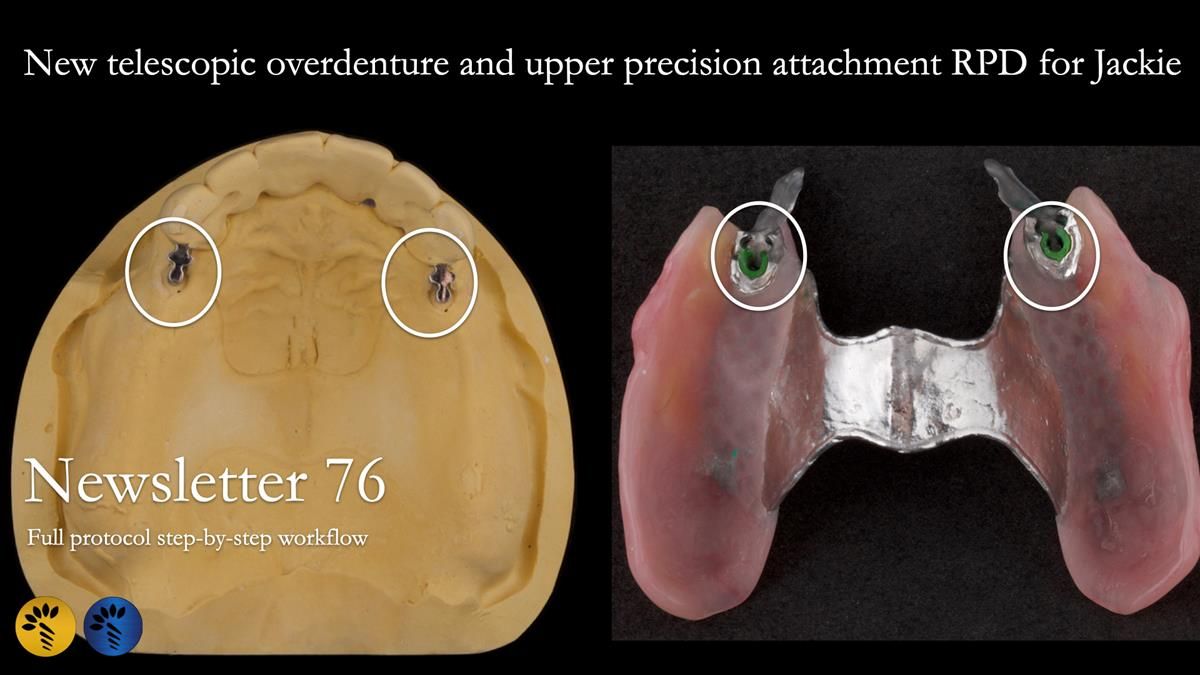 Newsletter 76: Jackie’s case – Telescopic overdenture & precision RPD (the tricky truth!)