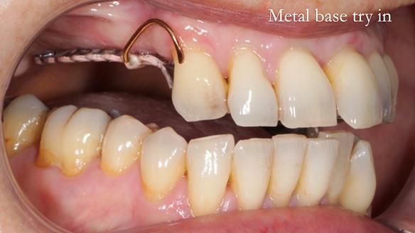 Newsletter 56 showing the making and fitting of a bilateral free end saddle upper removable partial denture (RPD) for patient with pemphigus