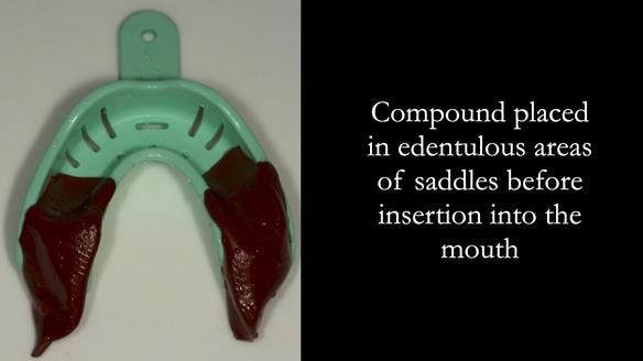 Finlay's Case Study Newsletter 40 - Immediate Mk 1 RPD to Definitive Mk 2 RPD - full protocol