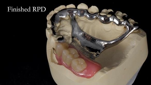 Finlay's Newsletter 64 case study - provision of a Kennedy class 2 metal based Scandinavian RPD for Ian