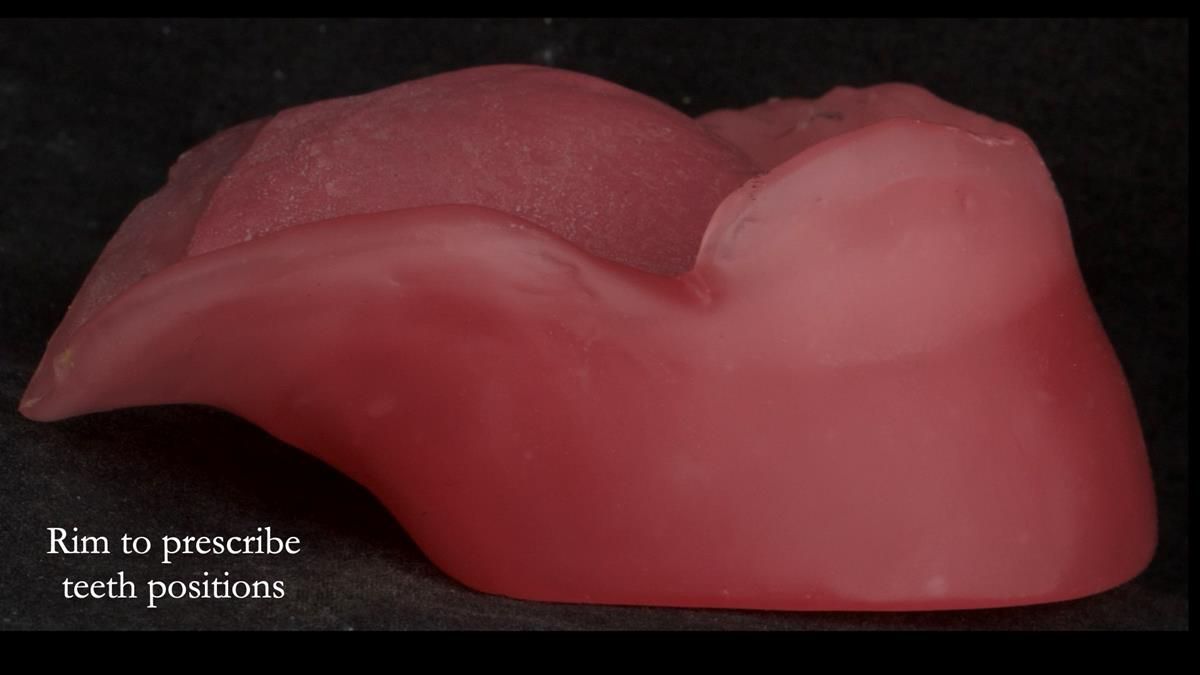 Newsletter 87 – Father Peter: A Partial Denture that needed Minor Miracle