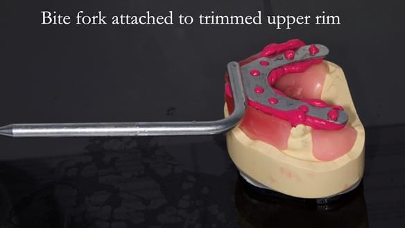 Newsletter 52 Managing Jo’s failing dentition with extractions and Mk 1/Mk 2 complete upper dentures and lower partial dentures FULL PROTOCOL