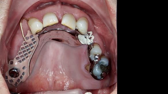 Newsletter 86 Peter the Architect — precision removable partial dentures case study
