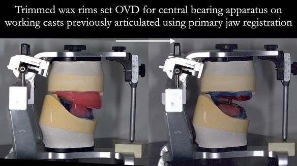 Newsletter 57 showcases the making and fitting process of implant-supported complete dentures for Alisdair