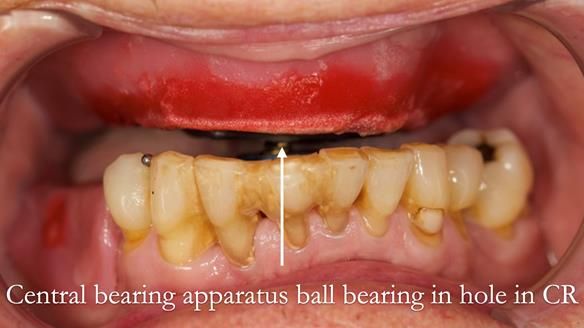 Newsletter 54 case presentation upper complete denture and lower Scandinavian designed hygienic partial denture for David