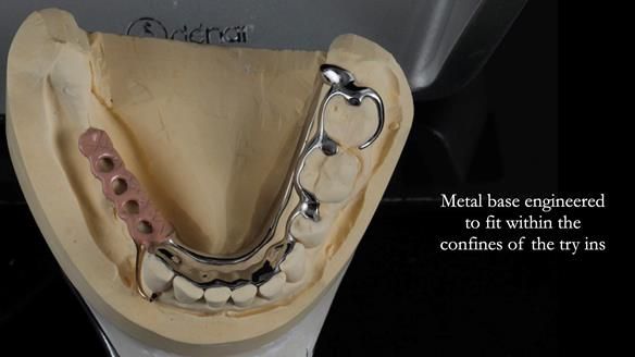 Finlay's Newsletter 61 provision of a lower unilateral free end saddle metal based partial denture for Joyce