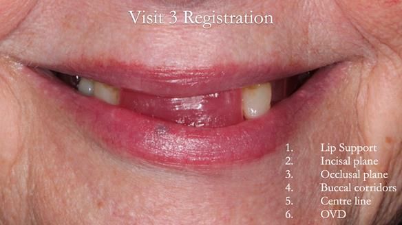 Finlay's Newsletter 59 Ultra hard partial dentures made for Gill