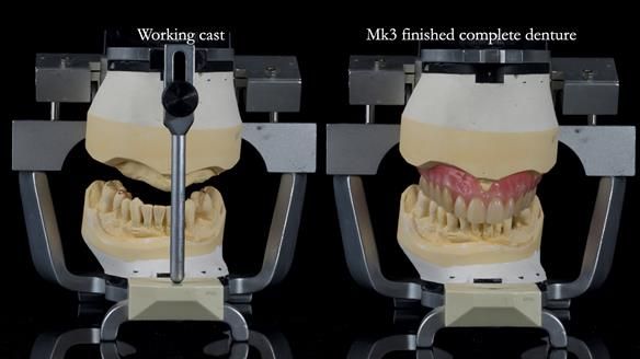 Newsletter 77: Jeremy’s case – immediate complete upper denture