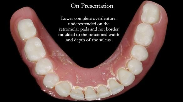 Newsletter 74: Ken’s Case Study Complete Dentures - Life Like and Age Appropriate