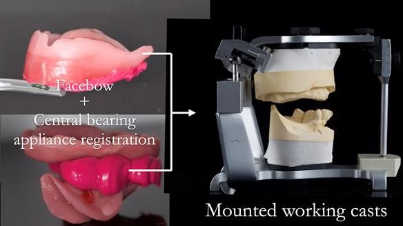 Newsletter 54 case presentation upper complete denture and lower Scandinavian designed hygienic partial denture for David