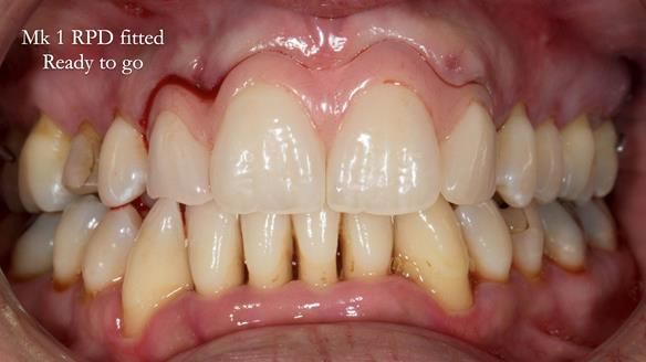 Finlay's Newsletter 63 Case study provision of metal based Scandinavian RPD - functional 10 years on