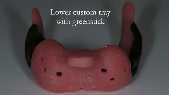 Finlay's Case Study Newsletter 40 - Immediate Mk 1 RPD to Definitive Mk 2 RPD - full protocol