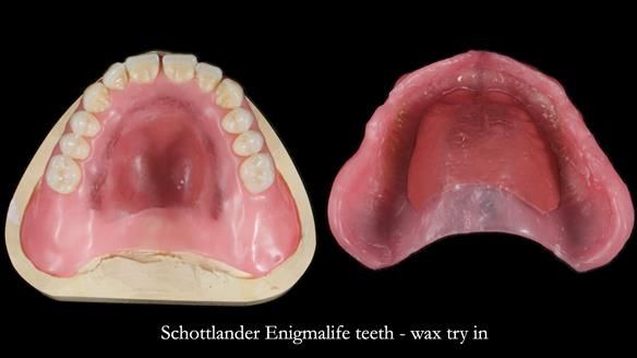 Newsletter 78: What do Clark Gable and a Locator® overdenture have in common?