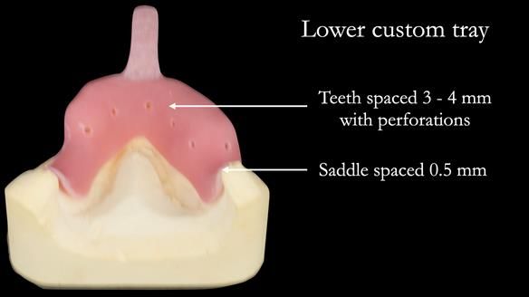 Newsletter 52 Managing Jo’s failing dentition with extractions and Mk 1/Mk 2 complete upper dentures and lower partial dentures FULL PROTOCOL