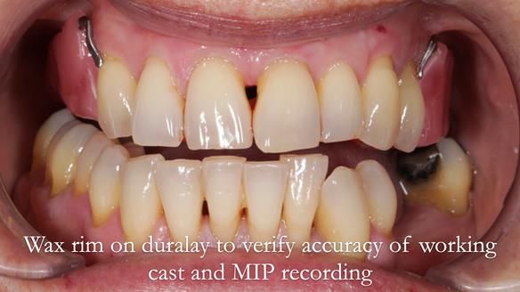 Newsletter 56 showing the making and fitting of a bilateral free end saddle upper removable partial denture (RPD) for patient with pemphigus