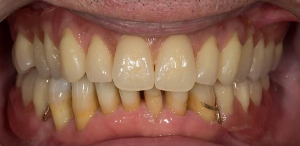 Figure 101 Mk 2 dentures try in - teeth in wax assessment of tooth positions and occlusion