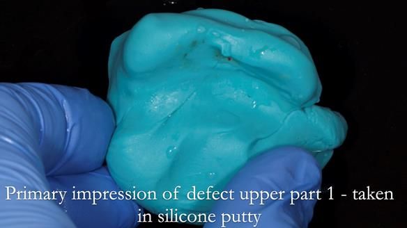 Upper metal base partial denture/occlusal stabilisation splint/obturator - full protocol