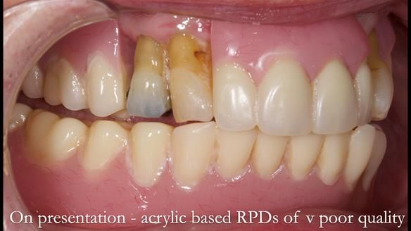 Finlay's Newsletter 59 Ultra hard partial dentures made for Gill