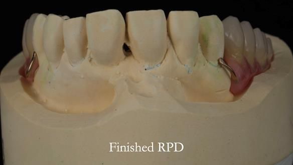 Newsletter 56 showing the making and fitting of a bilateral free end saddle upper removable partial denture (RPD) for patient with pemphigus