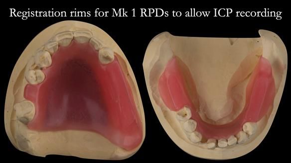 Finlay's Case Study Newsletter 40 - Immediate Mk 1 RPD to Definitive Mk 2 RPD - full protocol