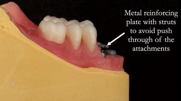 Reinforcement to implant supported dentures is crucial to reduced breakages