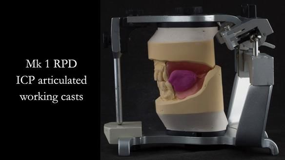 Finlay's Case Study Newsletter 40 - Immediate Mk 1 RPD to Definitive Mk 2 RPD - full protocol