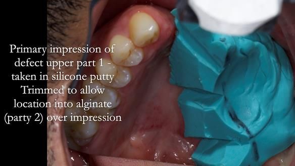 Upper metal base partial denture/occlusal stabilisation splint/obturator - full protocol