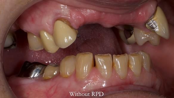 Newsletter 81 - Pam’s Story — how a partial denture changed her life (+ live walkthrough this Thursday)