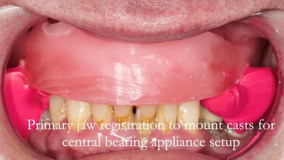 Newsletter 77: Jeremy’s case – immediate complete upper denture