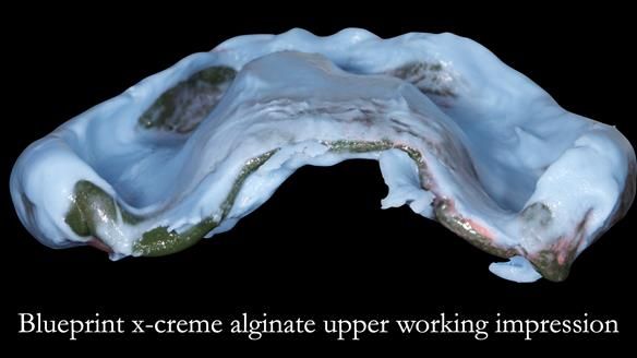 Newsletter 52 Managing Jo’s failing dentition with extractions and Mk 1/Mk 2 complete upper dentures and lower partial dentures FULL PROTOCOL