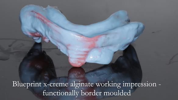 Finlay's Newsletter 59 Ultra hard partial dentures made for Gill