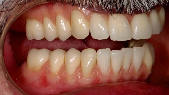 Newsletter 78: What do Clark Gable and a Locator® overdenture have in common?