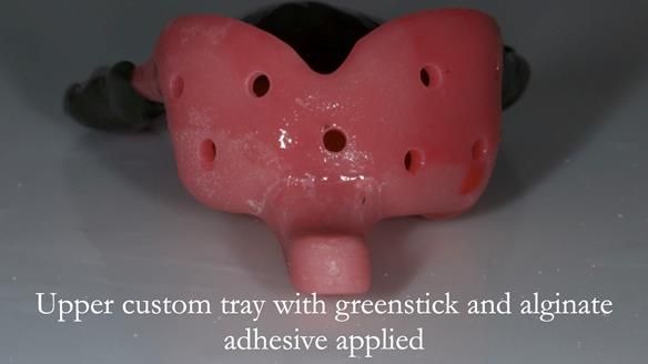 Finlay's Case Study Newsletter 40 - Immediate Mk 1 RPD to Definitive Mk 2 RPD - full protocol