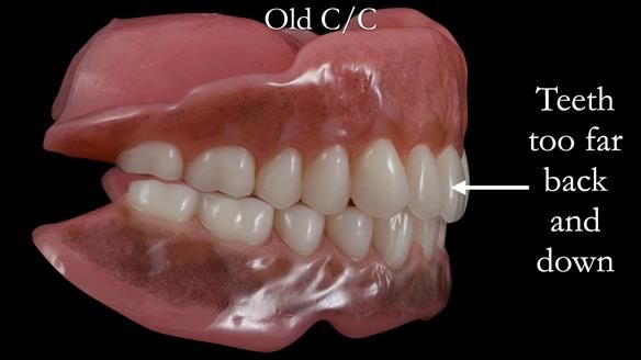 Newsletter 53 showing the making and fitting of ultra life-like dentures for Valena