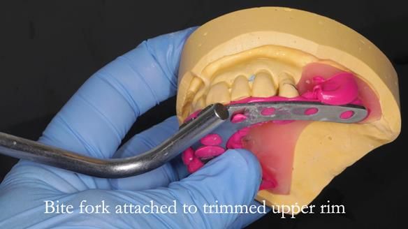 Newsletter 56 showing the making and fitting of a bilateral free end saddle upper removable partial denture (RPD) for patient with pemphigus