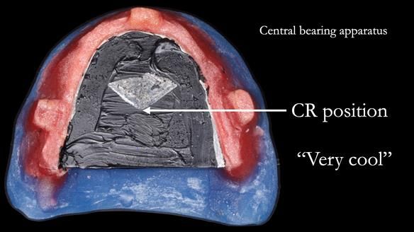 Newsletter 83: Sheila’s Complete Denture Success