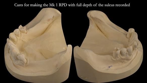 Finlay's Case Study Newsletter 40 - Immediate Mk 1 RPD to Definitive Mk 2 RPD - full protocol