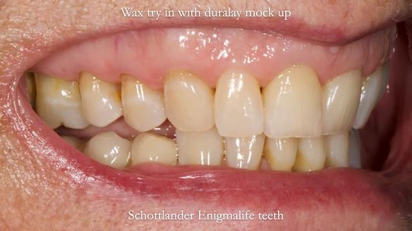 Finlay's Newsletter 61 provision of a lower unilateral free end saddle metal based partial denture for Joyce