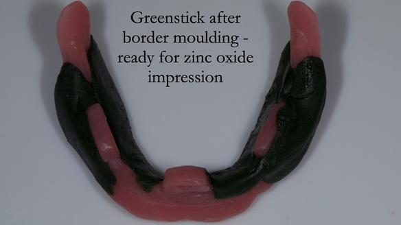 Complete denture Class II div 2 deep overbite Newsletter 39