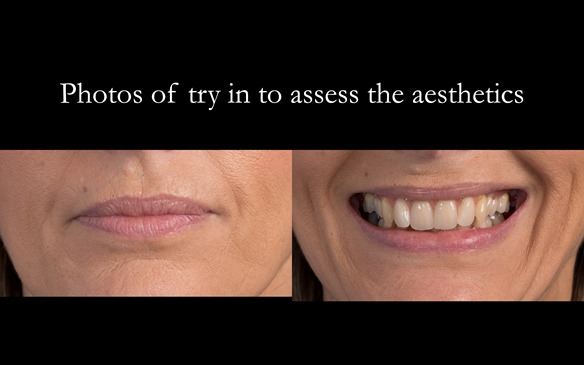 Figure 68 The patient also assesses the aesthetics in photographs and in a mirror of the try in