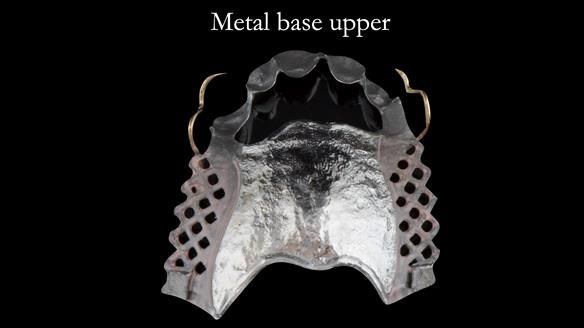 Finlay's Case Study Newsletter 40 - Immediate Mk 1 RPD to Definitive Mk 2 RPD - full protocol