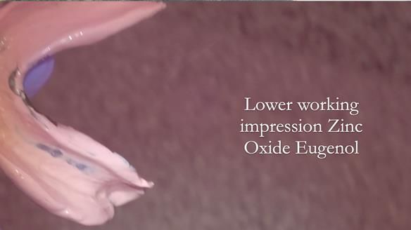 Finlay's Newsletter 62 provision of extractions and metal based complete dentures for Rafique