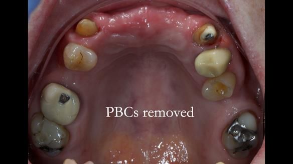 Newsletter 81 - Pam’s Story — how a partial denture changed her life (+ live walkthrough this Thursday)