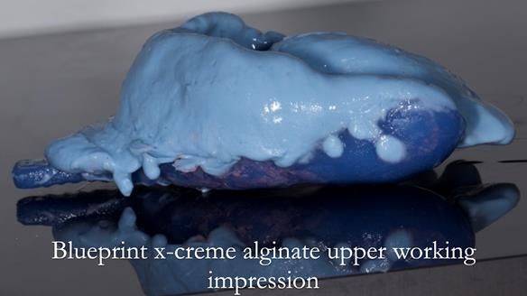 Finlay's Newsletter 64 case study - provision of a Kennedy class 2 metal based Scandinavian RPD for Ian