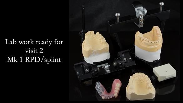 Newsletter 51 Managing Anne’s failing dentition with distal extension base RPD/Splint FULL PROTOCOL