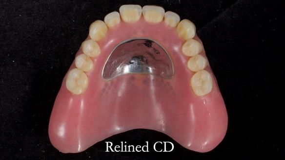 Finlay's Newsletter 62 provision of extractions and metal based complete dentures for Rafique