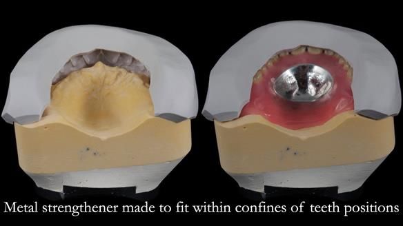 Finlay's Newsletter 62 provision of extractions and metal based complete dentures for Rafique