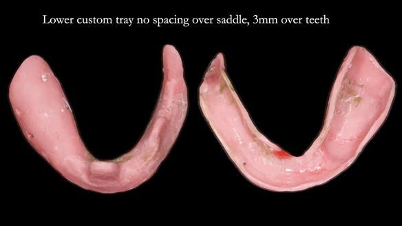 Newsletter 82 Mary - A complete upper and a one-tooth gasket denture